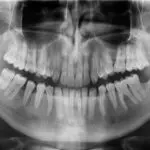 Bone Shattered for Beauty