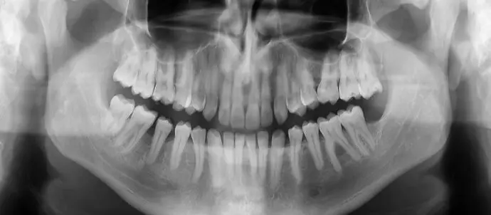 Bone Shattered for Beauty