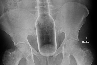 Big Brother in your bum